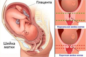 Короткая Матка При Беременности Что Это Значит