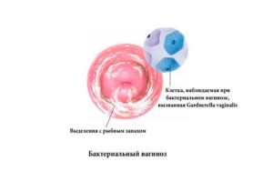 Гарднерелла у женщин симптомы и лечение при беременности