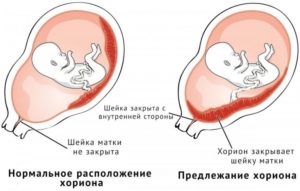 Низкая плацента 13 неделе беременности