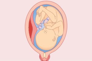 Воздух из матки при беременности на ранних сроках