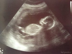 22 неделя беременности фото узи пол ребенка