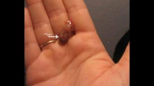 Как выглядит эмбрион в 5 недель фото при выкидыше