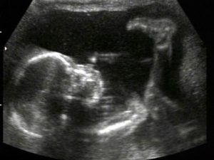 Фото узи на 21 неделе беременности пол ребенка