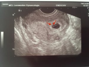 На узи не видно эмбриона 5 недель