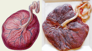 Что значит кальцинаты в плаценте