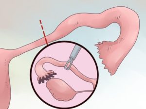 Последствия Внематочной Беременности С Удалением Трубы