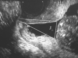 Раскрытие внутреннего зева при беременности 20 недель