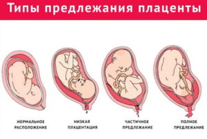Центральное предлежание плаценты при беременности 20 недель