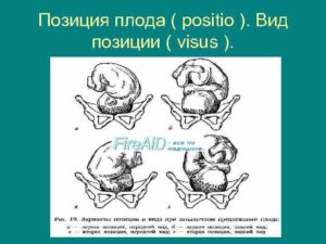 Положение плода продольное головное позиция 2 вид передний