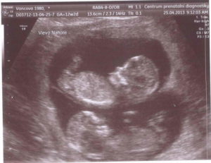 13 Неделя беременности двойней фото