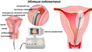 Можно ли забеременеть при гиперплазии эндометрия матки