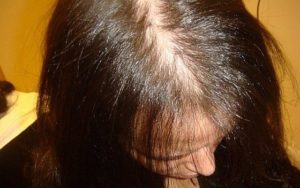 Гормоны для роста волос на голове у женщин