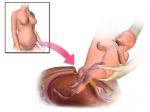 Стимуляция родов на 38 неделе беременности