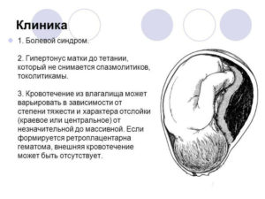 Выделения Во Время Беременности При Гематоме