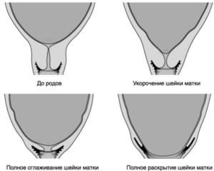 Мягкая шейка матки когда роды