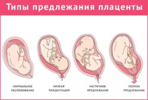 Как поднять плаценту при низкой плацентации по передней стенке