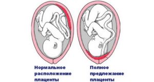 Краевое предлежание плаценты что значит