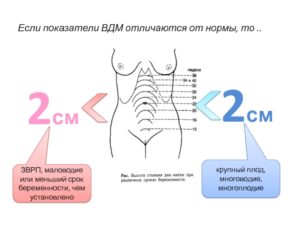 Высота дна матки не соответствует сроку беременности