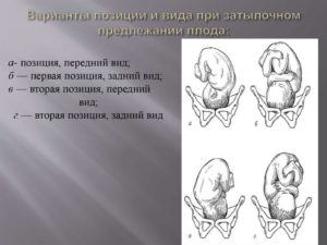 Положение плода продольное предлежание головное 1 позиция передний вид