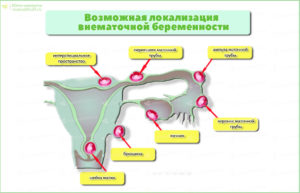 Растет матка при внематочной беременности