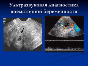 Можно Ли Определить На Узи Внематочную Беременность