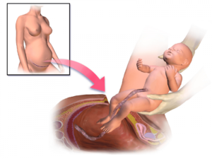 Симптомы расхождения шва на матке после кесарева во время беременности