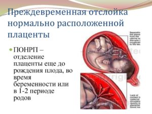 Отек плаценты при беременности причины