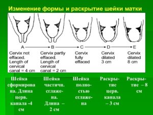 Короткая Матка При Беременности Что Это Значит