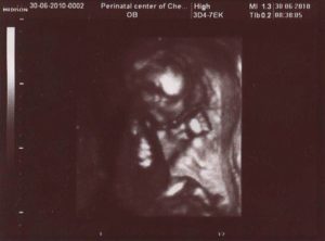 Плацента на 17 недели беременности
