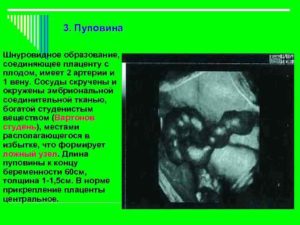 В пуповине 3 сосуда при беременности что это значит