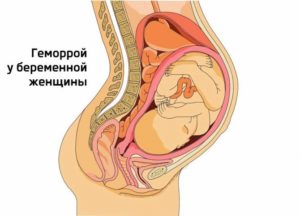 Геморрой на 38 неделе беременности что делать