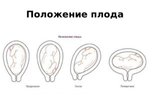 Косое положение плода при беременности на 30 неделе беременности