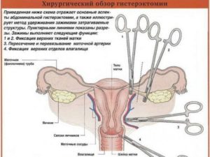 Гормонозаместительная терапия после удаления яичников и матки