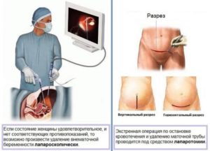 Возможно Ли Сохранить Трубу При Внематочной Беременности