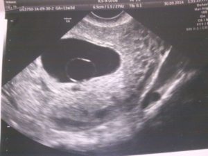 Не видно эмбриона на 8 неделе беременности