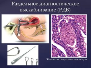 Гиперплазия эндометрия при менопаузе выскабливание отзывы