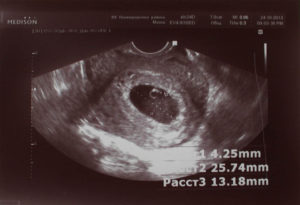 Фото узи 5 6 недель беременности фото