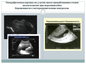 Неразвивающаяся беременность 7 недель