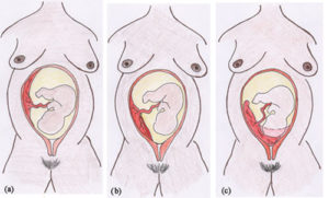 Эмбрион прикрепился к задней стенке матки