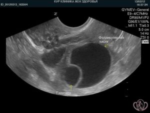 Киста яичника в постменопаузе форум