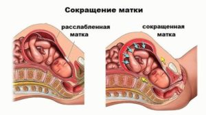 Тонус матки при беременности на 27 неделе беременности