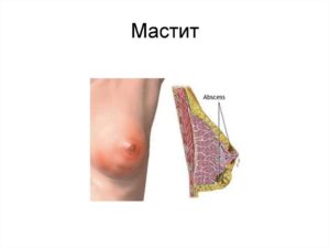 Покраснение на груди при гв