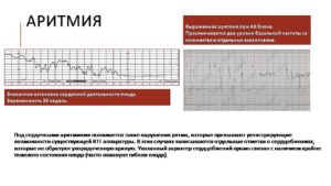 Начальные Нарушения Состояния Плода При Ктг Причины