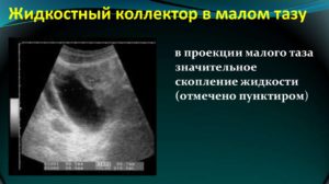 Свободная жидкость в малом тазу в небольшом количестве при беременности