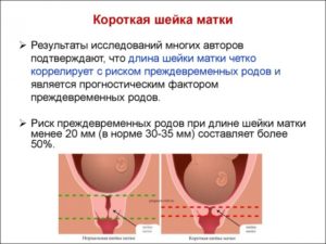 Укорочение шейки матки при беременности 27 недель