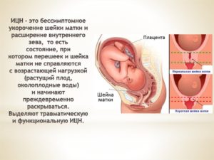 Короткая Шейка Матки На 30 Неделе Беременности