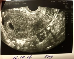 Почему на 5 неделе беременности не видно эмбриона