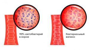 Гарднерелла на беременность как влияет