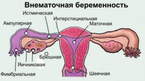 Грудь при внематочной беременности набухает