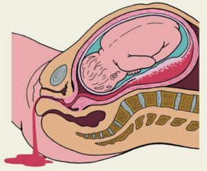 Выделения Во Время Беременности При Гематоме